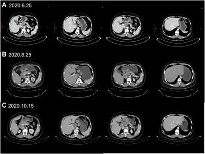 Adding of apatinib and camrelizumab to overcome de novo trastuzumab resistance of HER2-positive gastric cancer: A case report and literature review